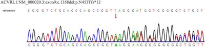 Case Report: Clinical characteristics and genetic analysis of two patients with hereditary hemorrhagic telangiectasia